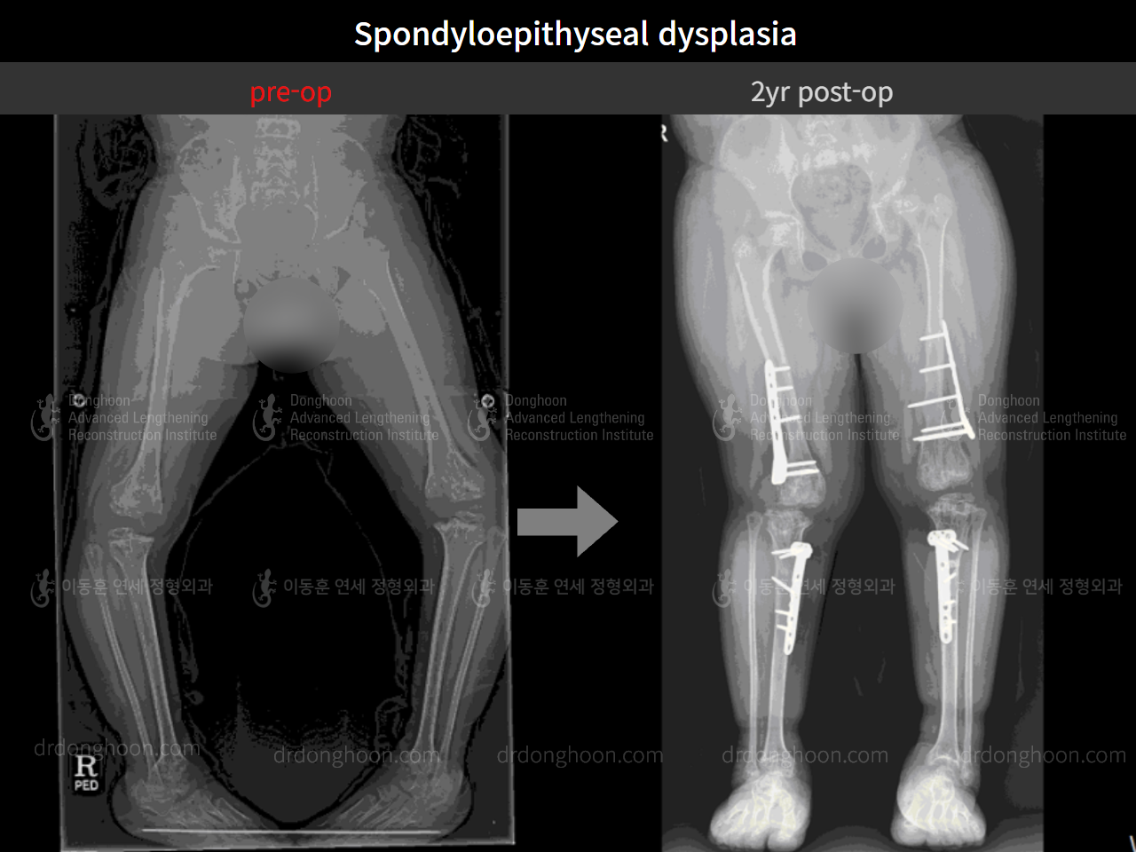 Before and after paediatric congenital condition, case 4304778, image 5, Dr. Donghoon institute (DALRI)