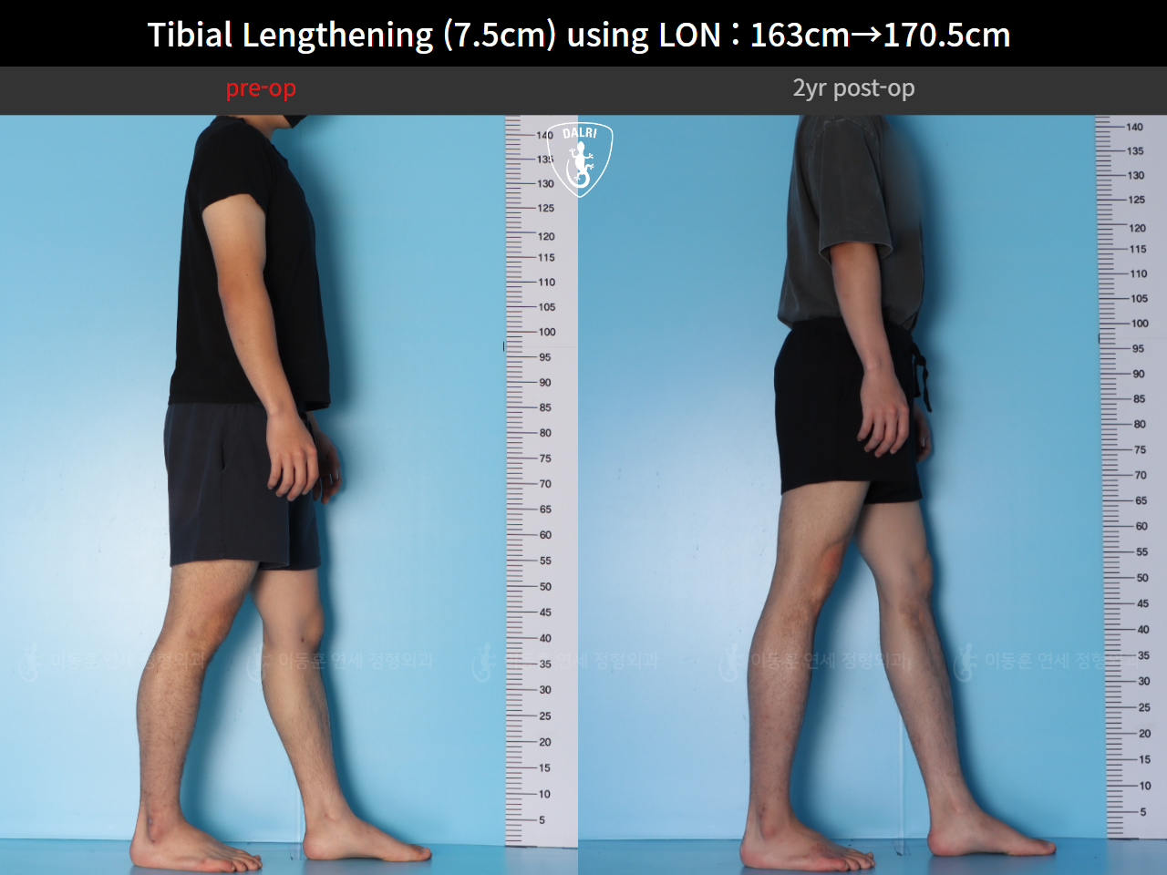 Before and after cll lon, case 125785462, image 8, Dr. Donghoon institute (DALRI)