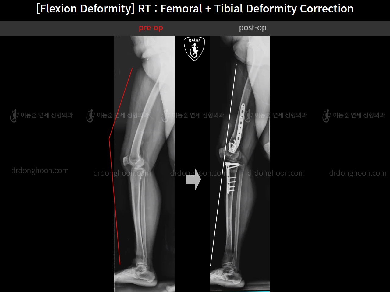 Before and after flexion deformity, case 15993081, image 6, Dr. Donghoon institute (DALRI)