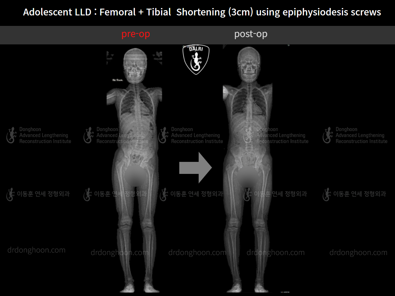 Before and after paediatric & adolescent lld, case 11511257, image 6, Dr. Donghoon institute (DALRI)