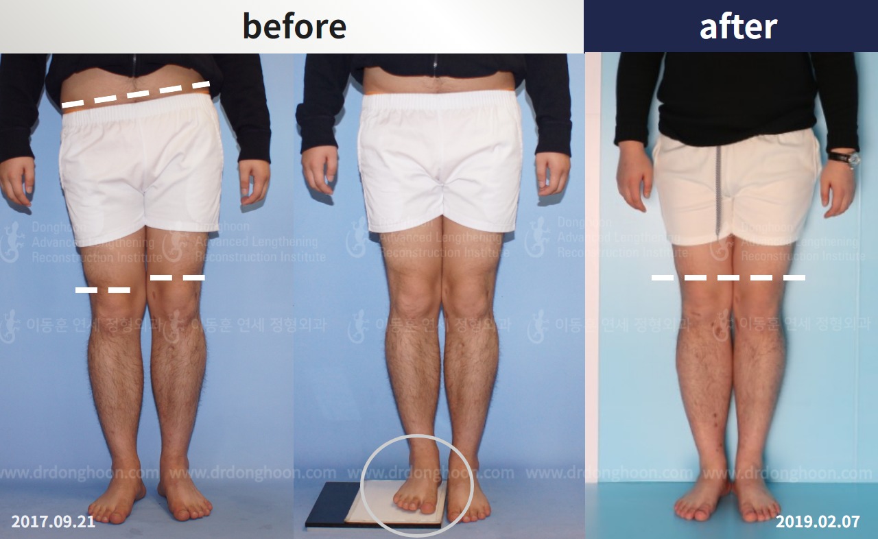 Before and after adult lld, case 4320305, image 1, Dr. Donghoon institute (DALRI)