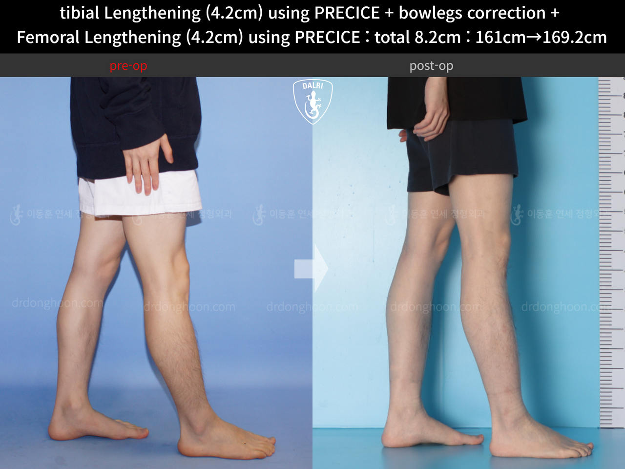 Before and after cll + deformity correction, case 14235715, image 7, Dr. Donghoon institute (DALRI)