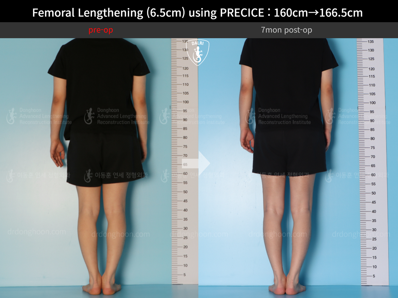 Before and after cll precice, case 13413485, image 2, Dr. Donghoon institute (DALRI)