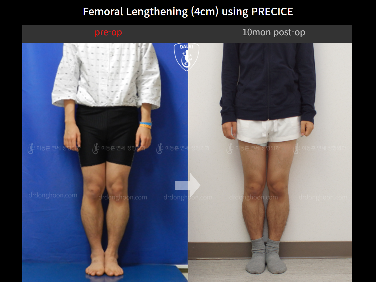 Before and after cll precice, case 4323369, image 3, Dr. Donghoon institute (DALRI)