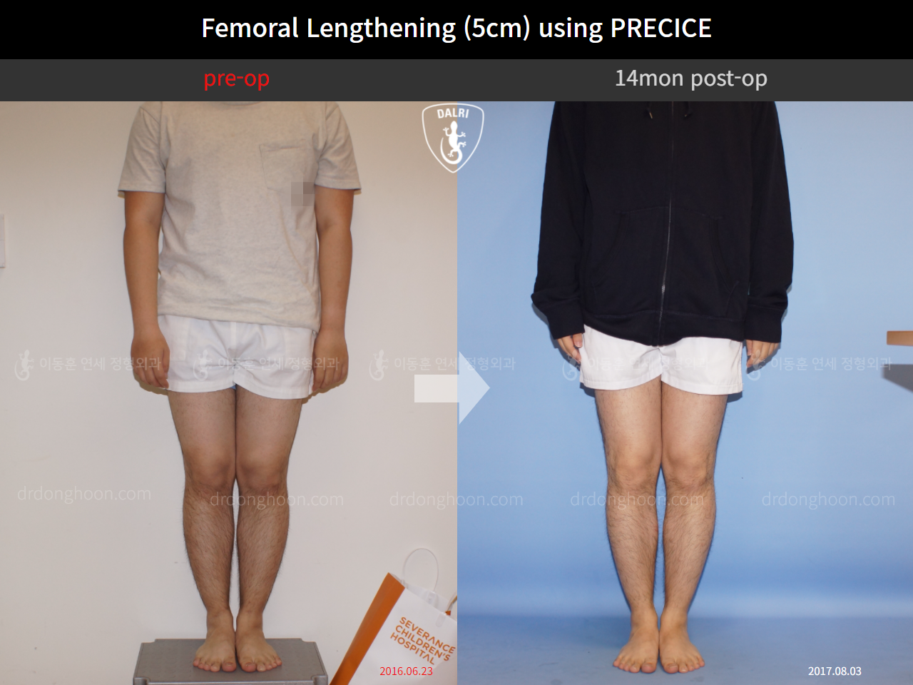 Before and after cll precice, case 4323249, image 1, Dr. Donghoon institute (DALRI)