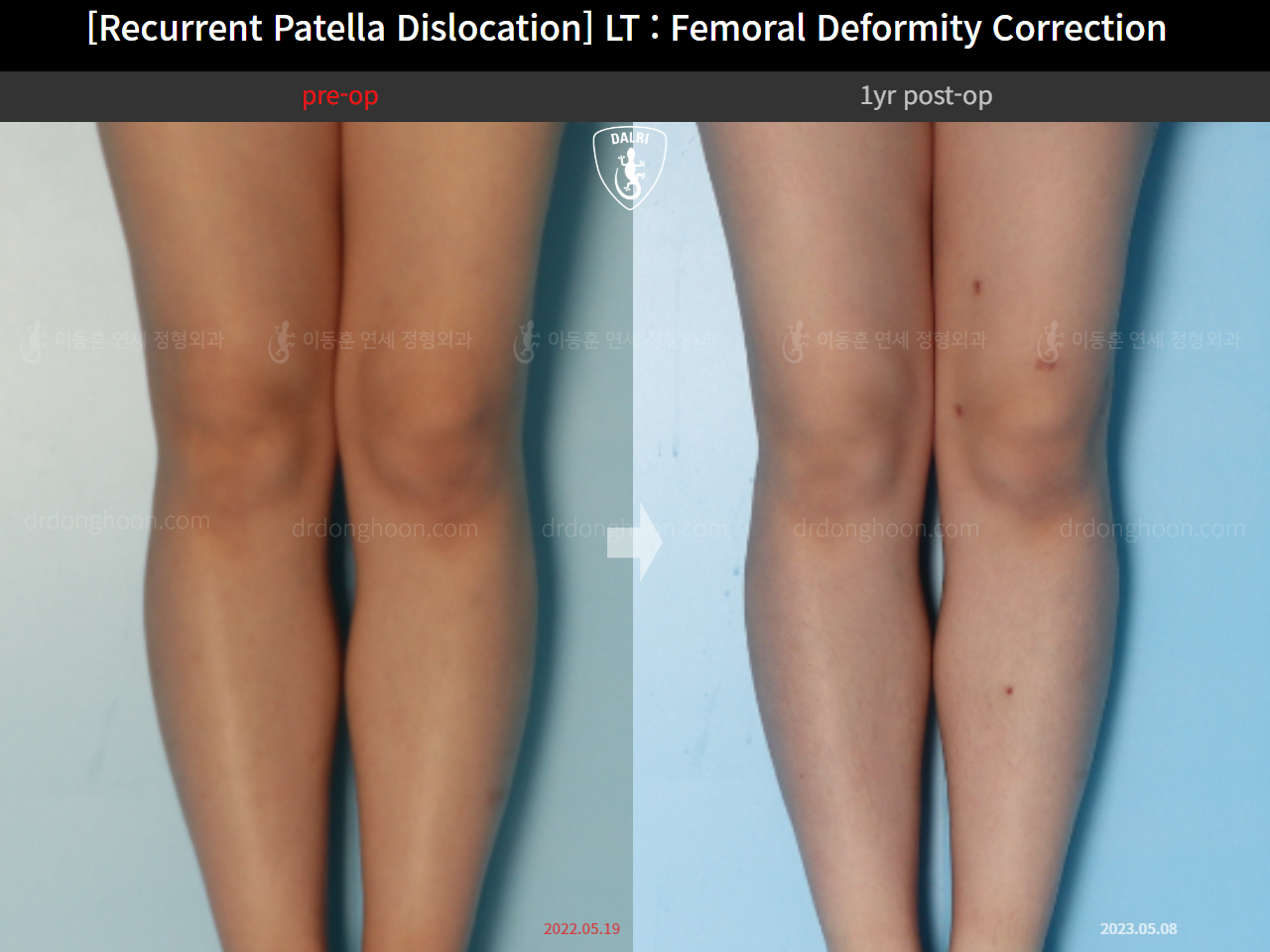Before and after recurrent patella dislocation, case 15125370, image 4, Dr. Donghoon institute (DALRI)