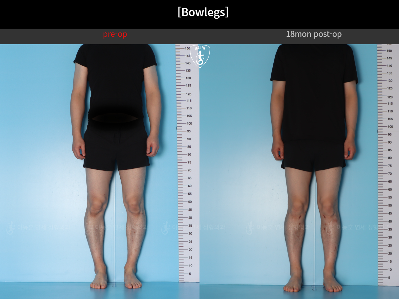 Before and after adult bowlegs, case 124254182, image 3, Dr. Donghoon institute (DALRI)