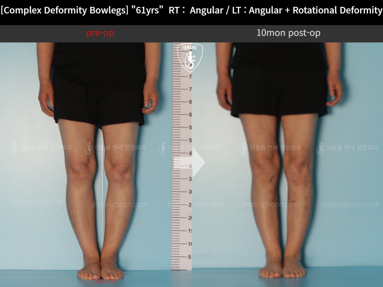 Before and after osteotomy for knee osteoarthritis, case 11576611, image 5, Dr. Donghoon institute (DALRI)