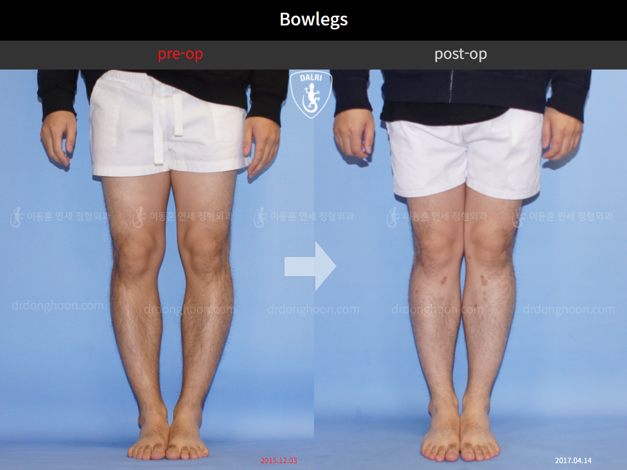 Before and after adult bowlegs, case 10628993, image 3, Dr. Donghoon institute (DALRI)
