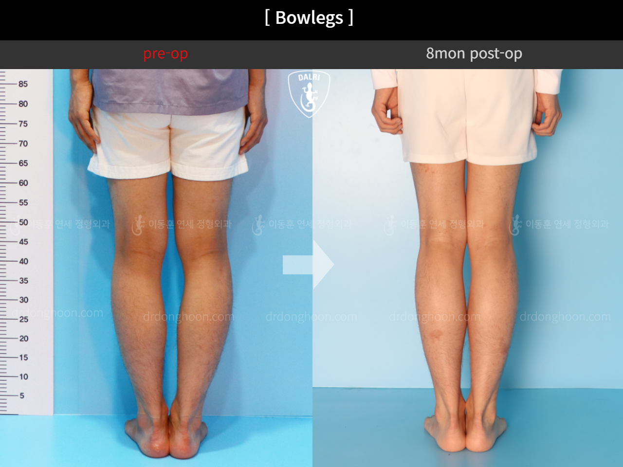 Before and after adult bowlegs, case 4311053, image 6, Dr. Donghoon institute (DALRI)