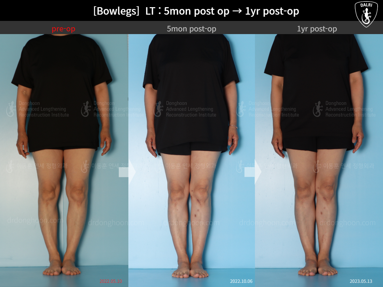 Before and after adult bowlegs, case 15172734, image 1, Dr. Donghoon institute (DALRI)