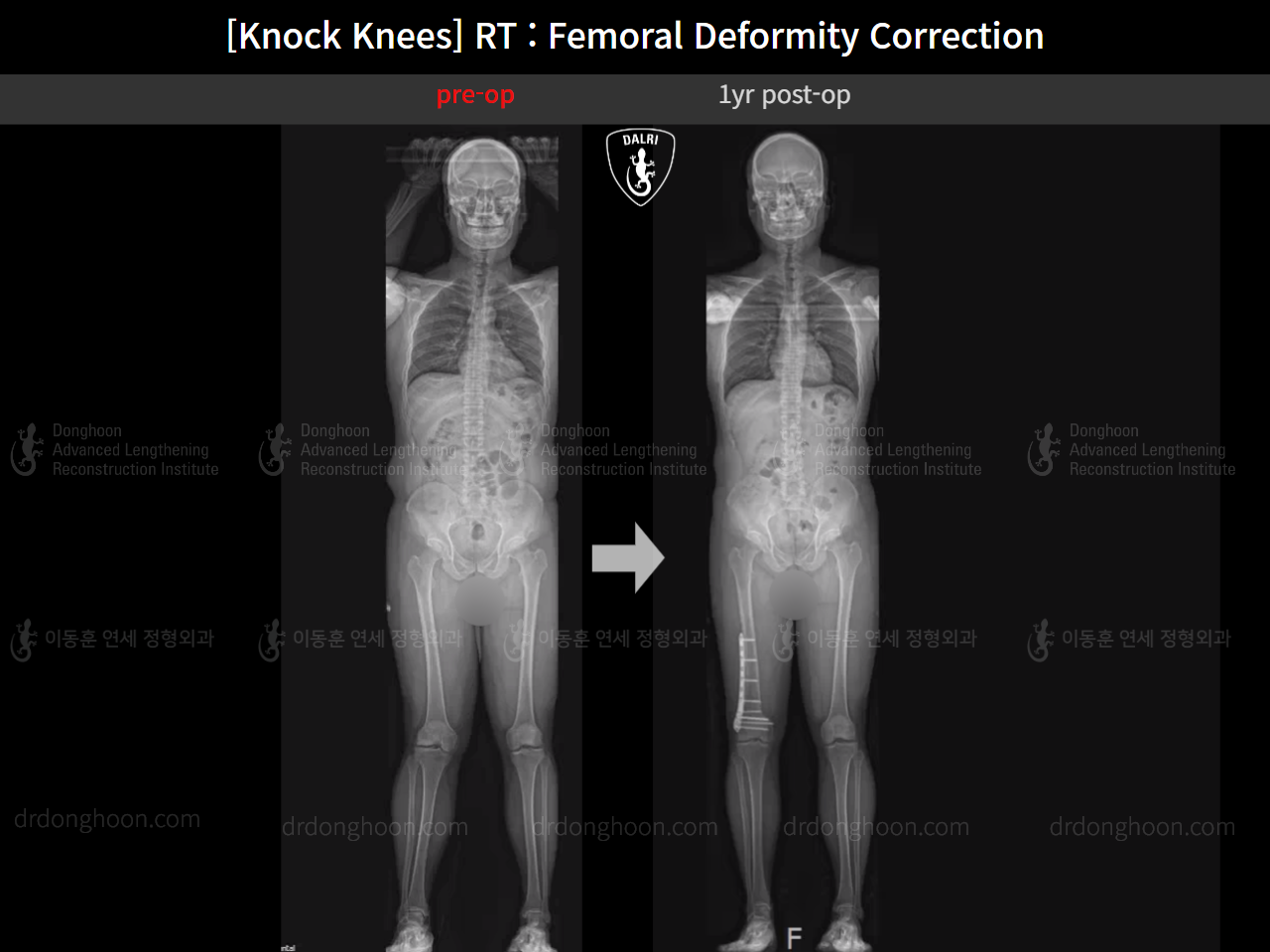Before and after adult knock knees, case 15950751, image 13, Dr. Donghoon institute (DALRI)