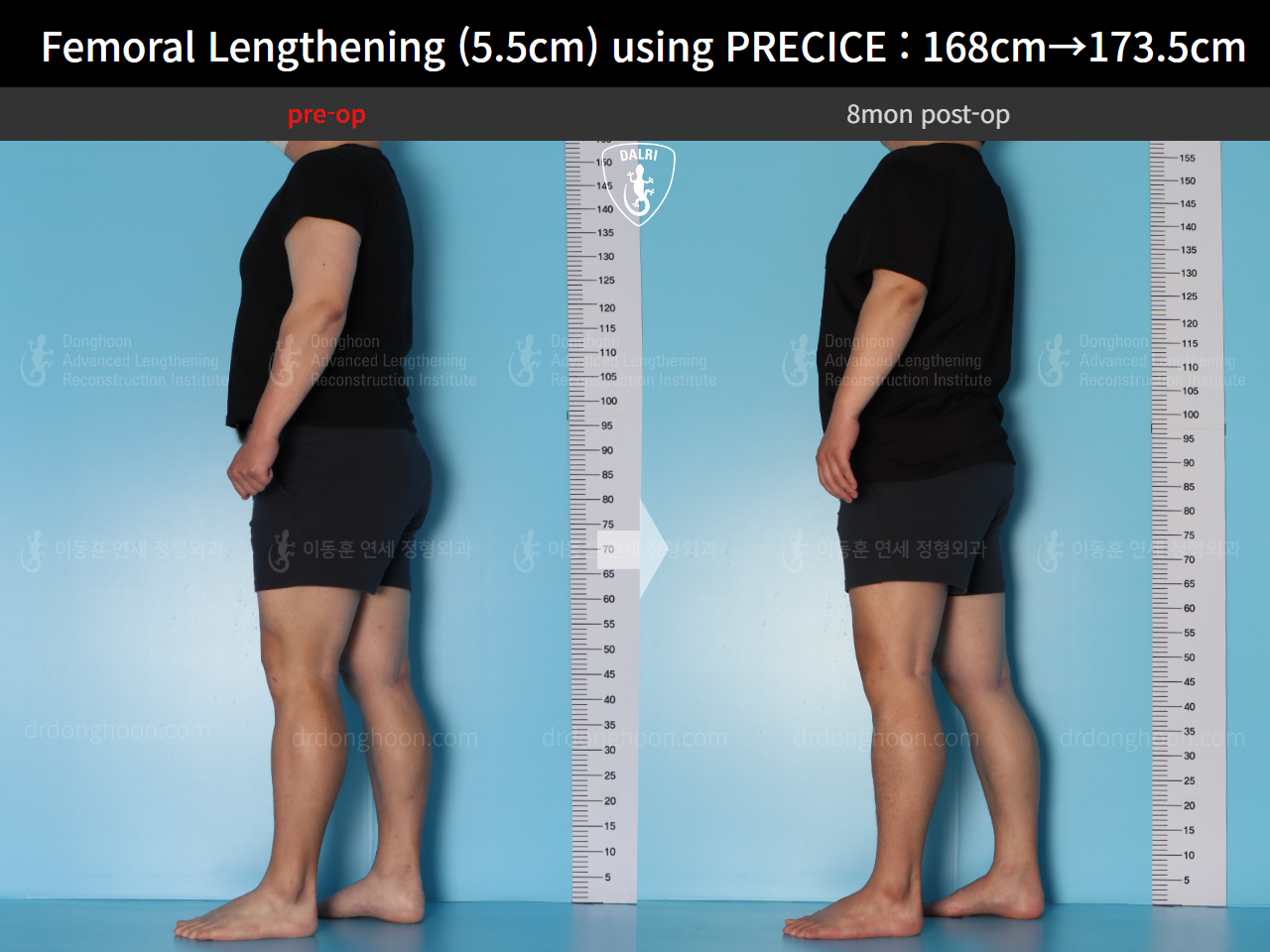Before and after cll precice, case 16910900, image 3, Dr. Donghoon institute (DALRI)