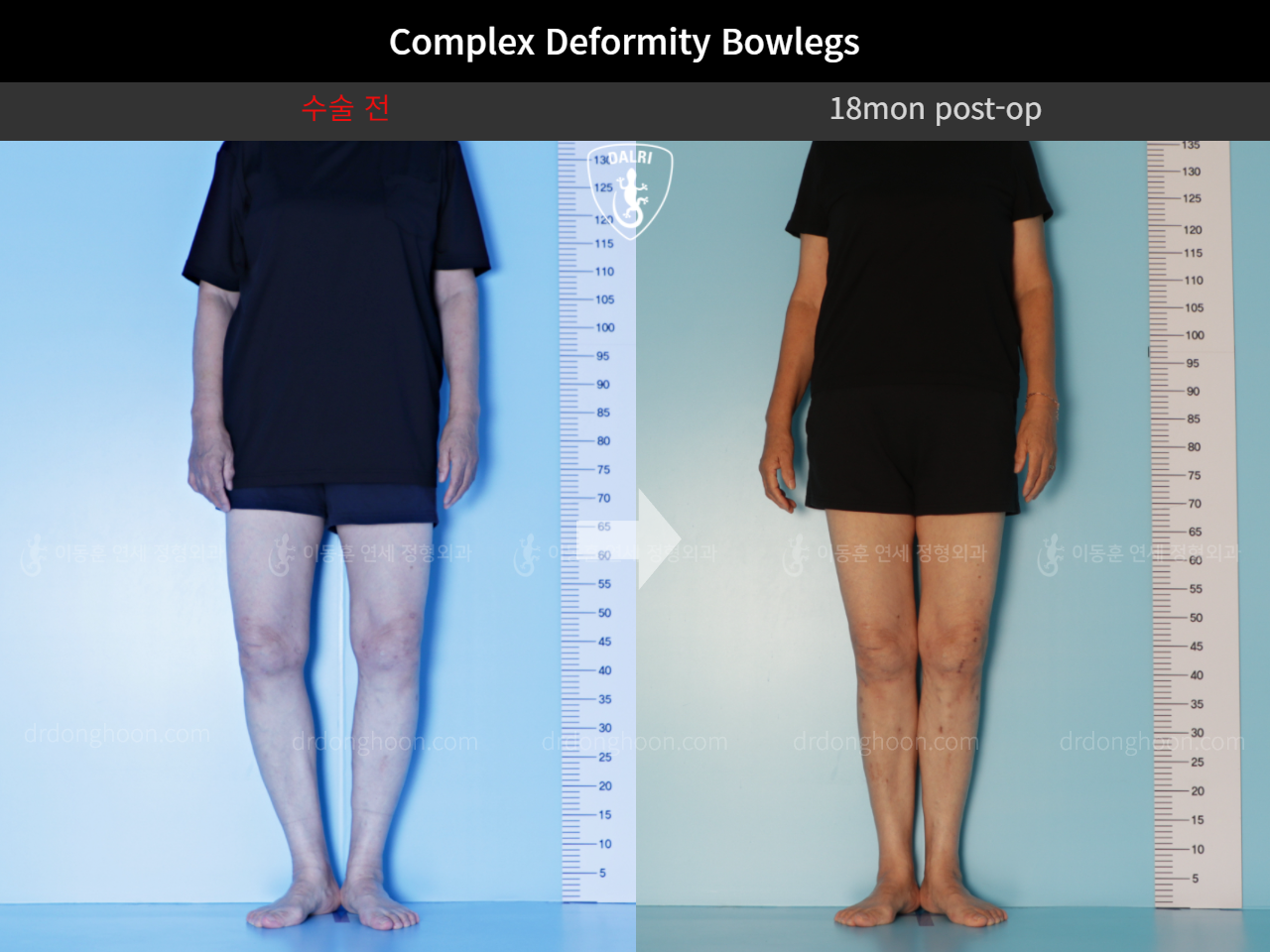 Before and after adult bowlegs, case 11337461, image 3, Dr. Donghoon institute (DALRI)