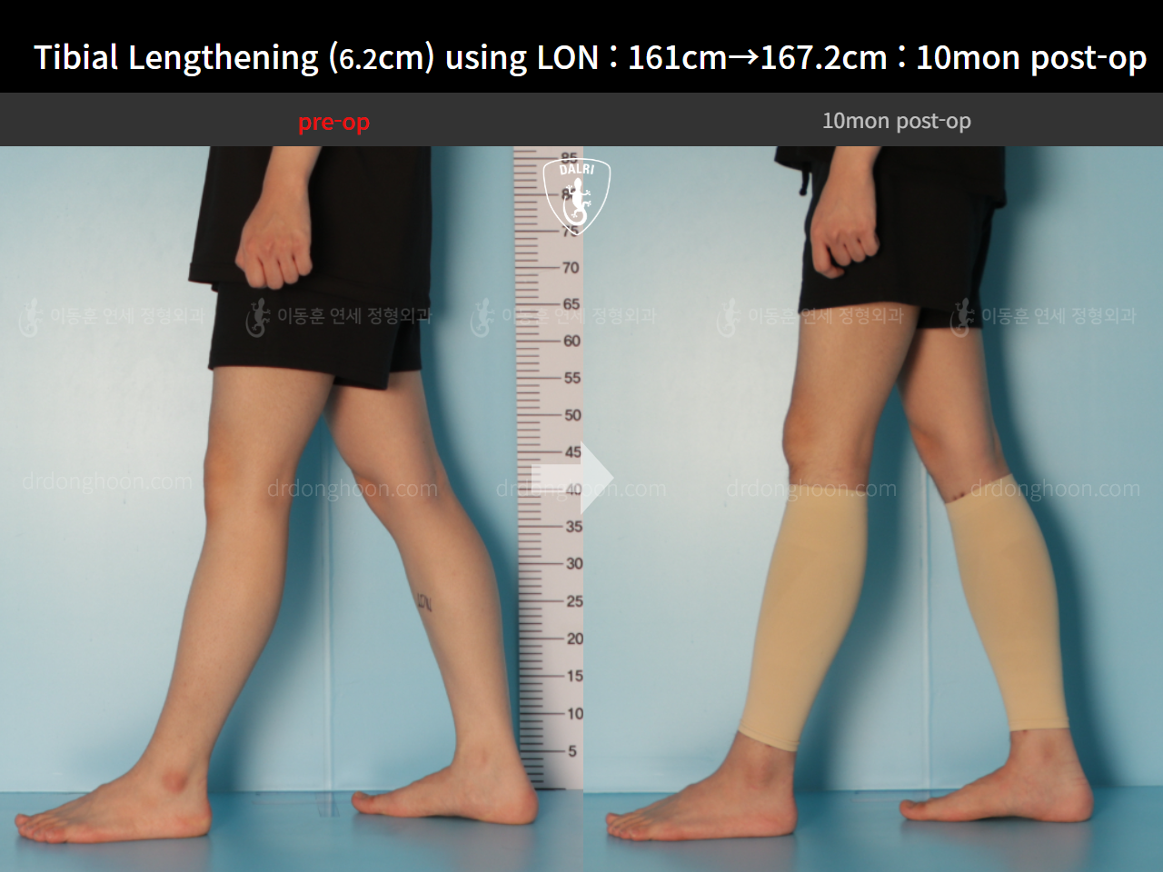 Before and after cll lon, case 14502141, image 8, Dr. Donghoon institute (DALRI)
