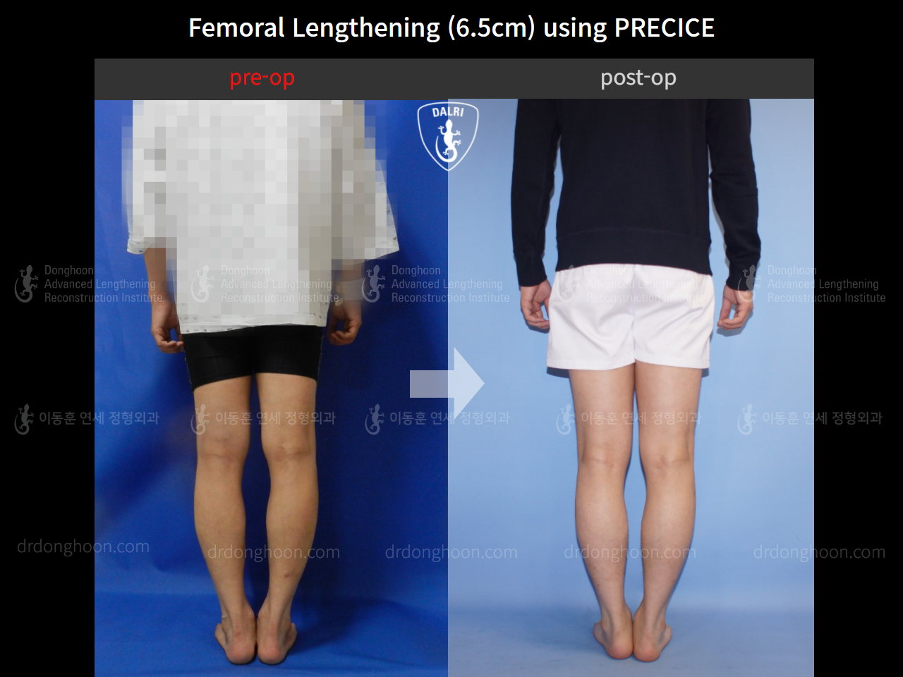 Before and after cll precice, case 4323401, image 2, Dr. Donghoon institute (DALRI)
