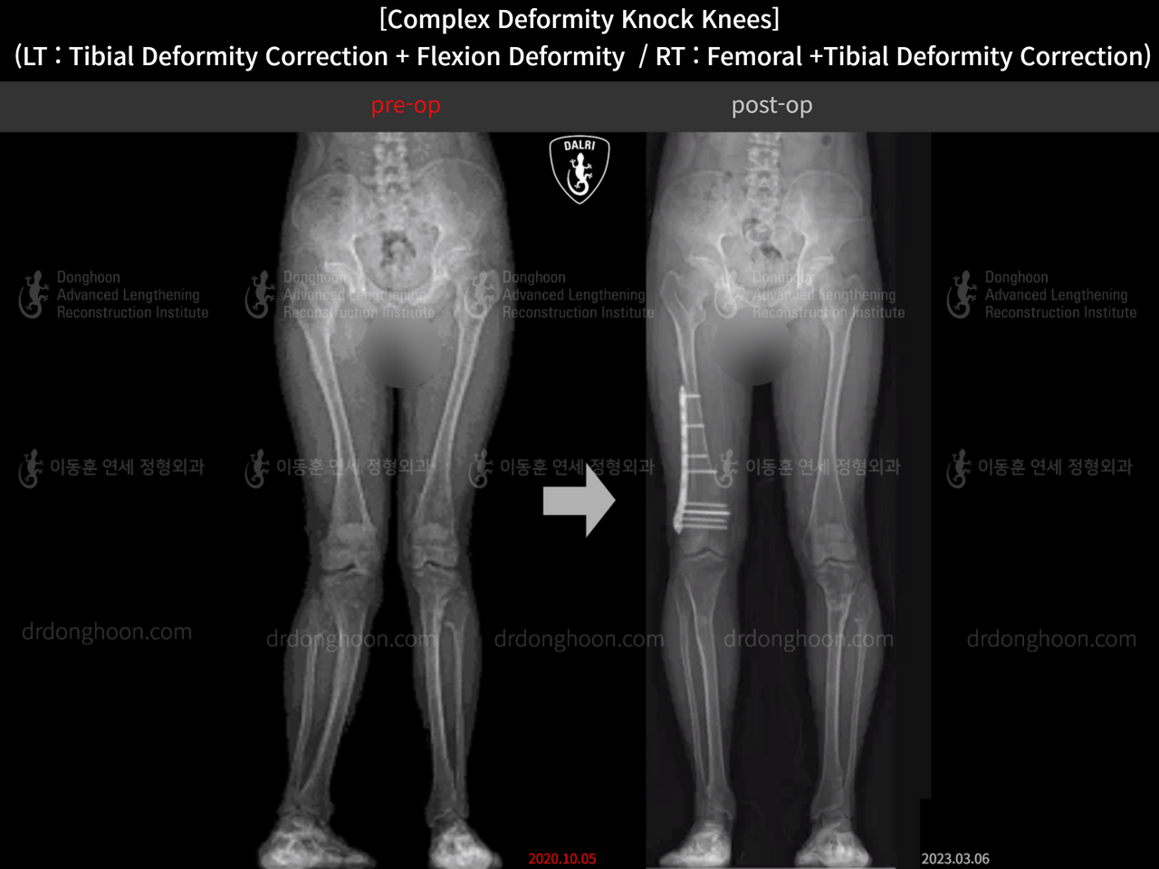 Before and after flexion deformity, case 14439359, image 6, Dr. Donghoon institute (DALRI)