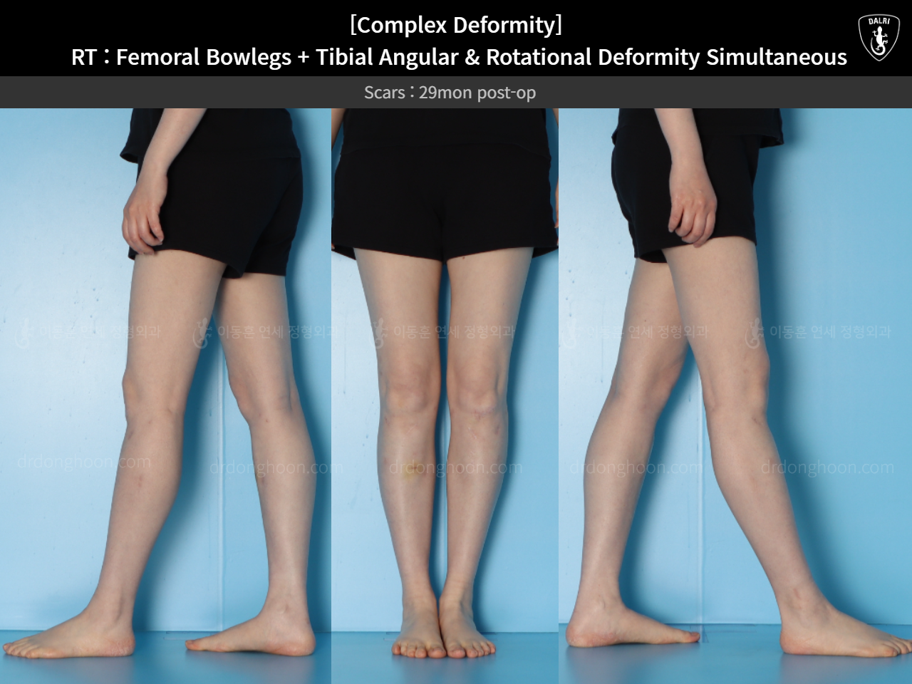 Before and after adult bowlegs, case 14771490, image 12, Dr. Donghoon institute (DALRI)