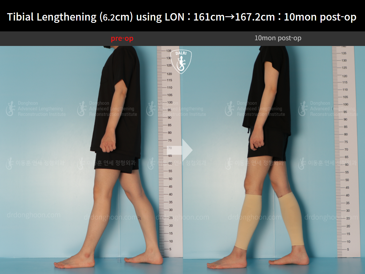Before and after cll lon, case 14502141, image 4, Dr. Donghoon institute (DALRI)