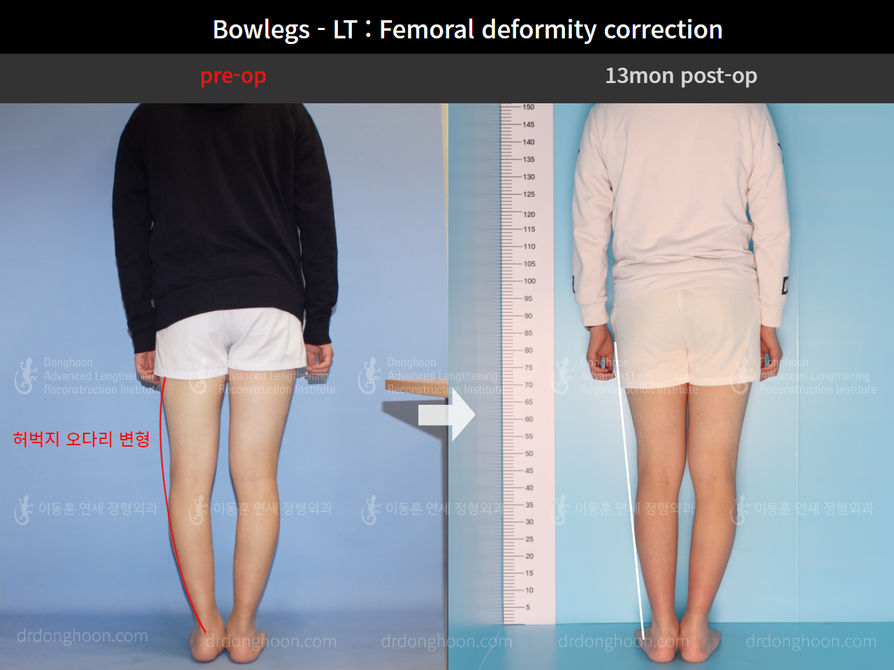 Before and after adult bowlegs, case 8932864, image 3, Dr. Donghoon institute (DALRI)