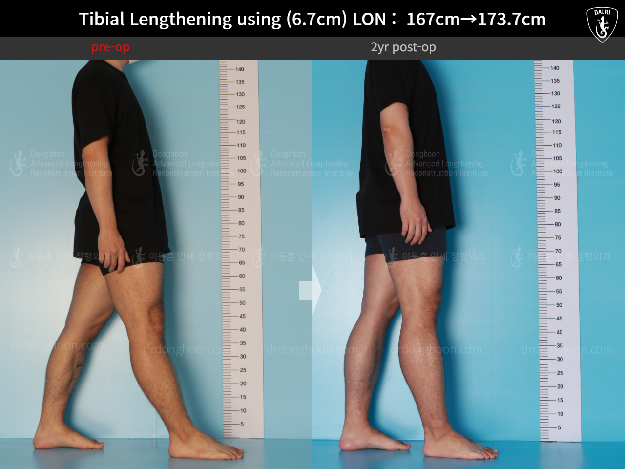 Before and after cll lon, case 16165376, image 5, Dr. Donghoon institute (DALRI)