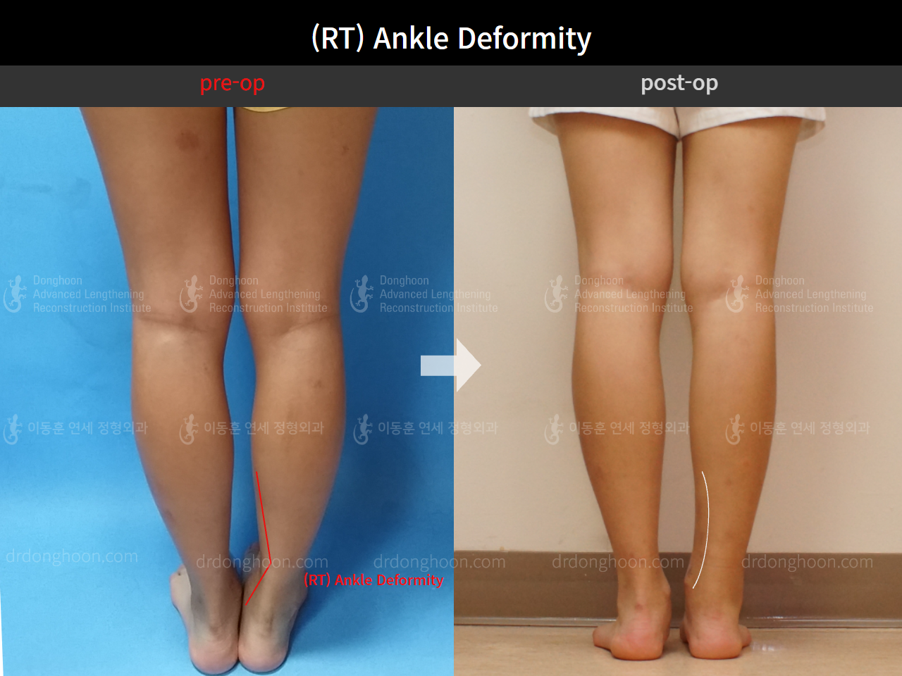 Before and after foot & ankle deformity, case 4248008, image 2, Dr. Donghoon institute (DALRI)