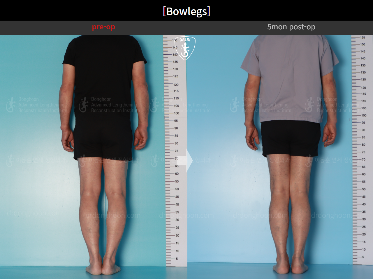 Before and after adult bowlegs, case 24988060, image 3, Dr. Donghoon institute (DALRI)