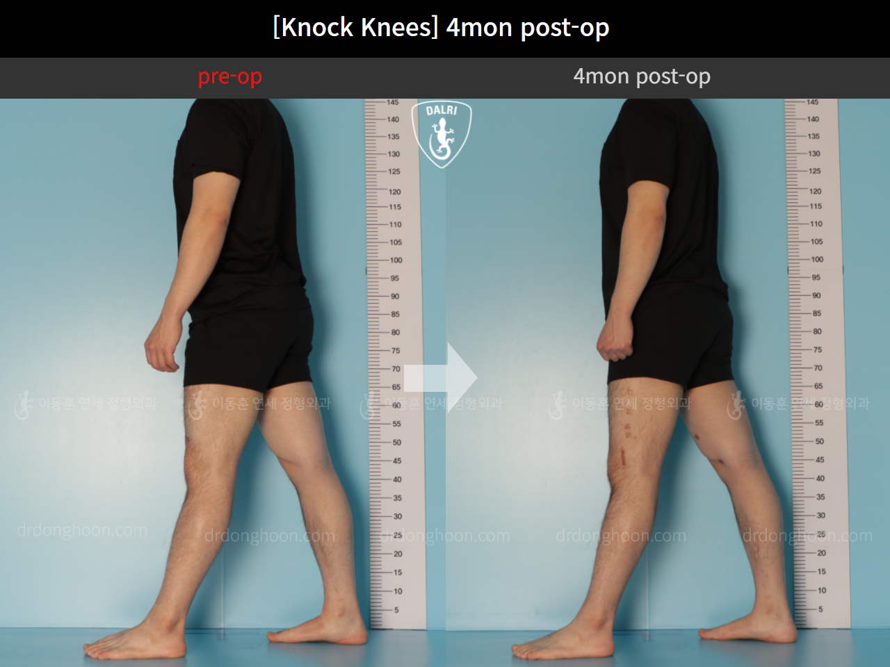 Before and after adult knock knees, case 10599771, image 3, Dr. Donghoon institute (DALRI)