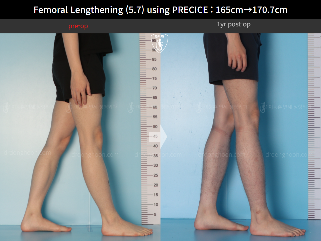 Before and after cll precice, case 15417090, image 9, Dr. Donghoon institute (DALRI)