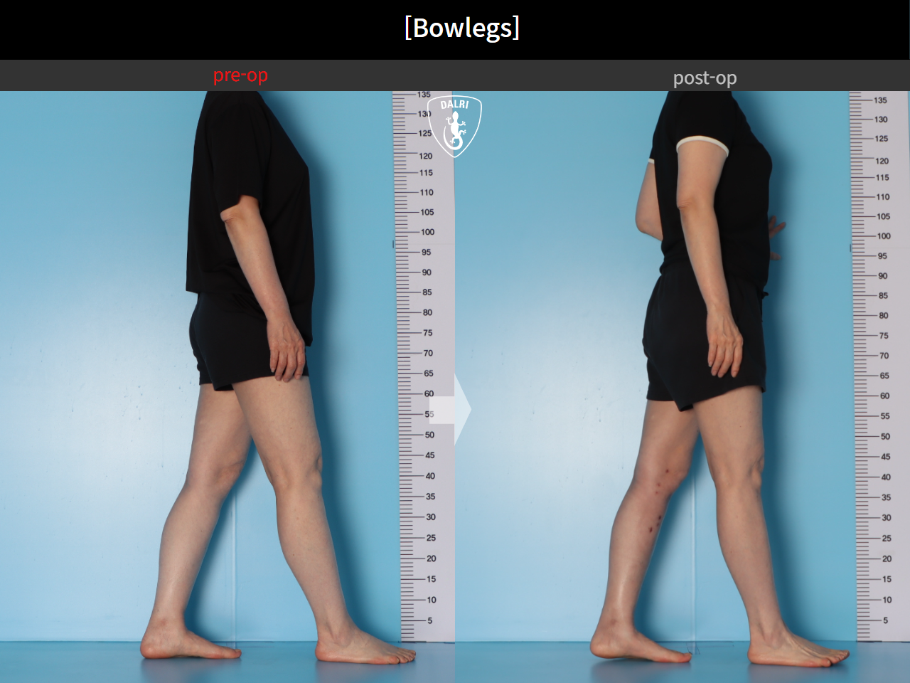 Before and after adult bowlegs, case 30256399, image 7, Dr. Donghoon institute (DALRI)