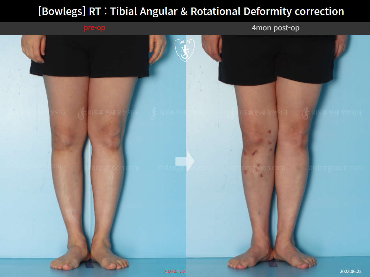 Before and after adult bowlegs, case 15741874, image 7, Dr. Donghoon institute (DALRI)