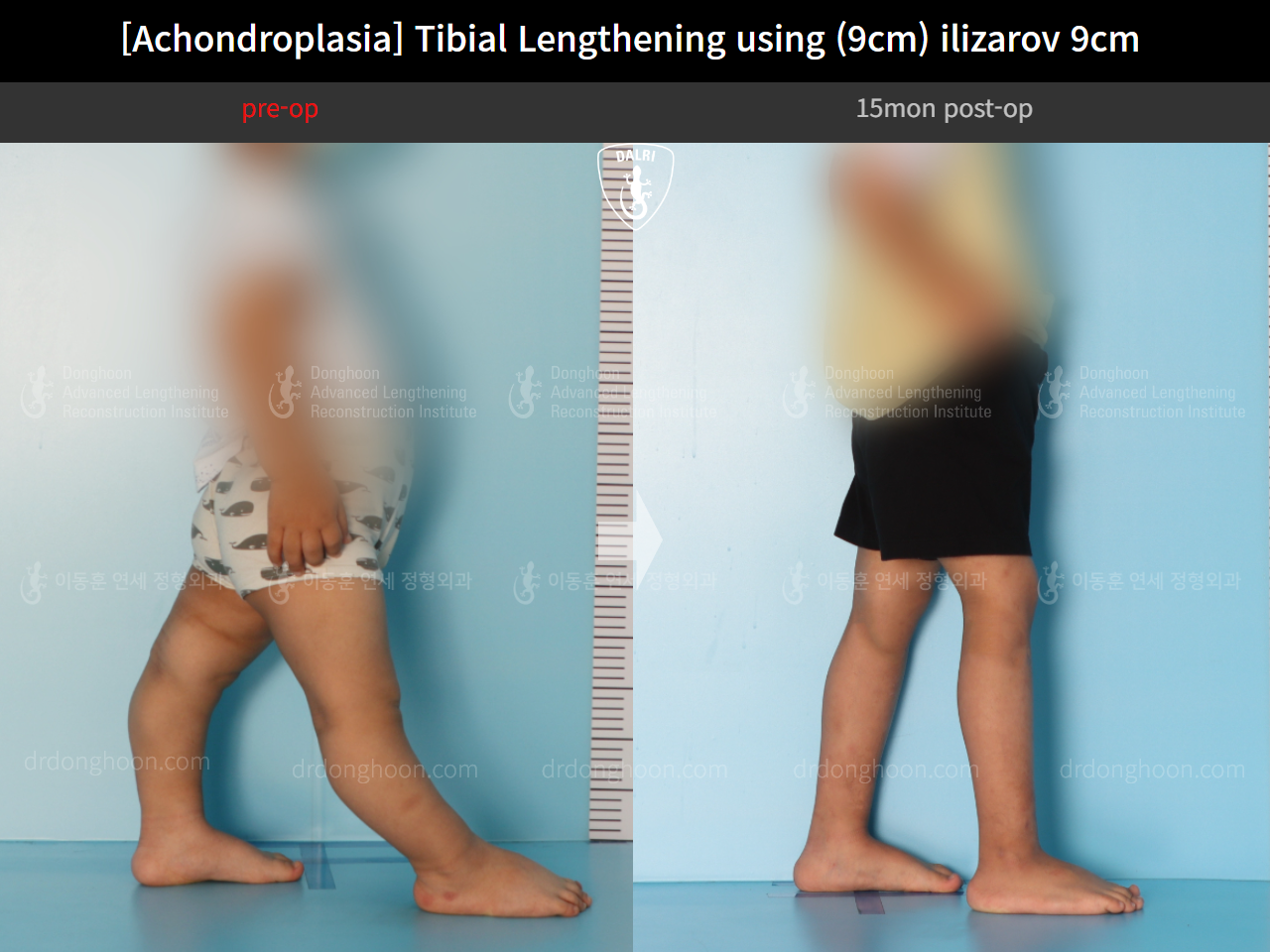 Before and after paediatric congenital condition, case 14542054, image 4, Dr. Donghoon institute (DALRI)