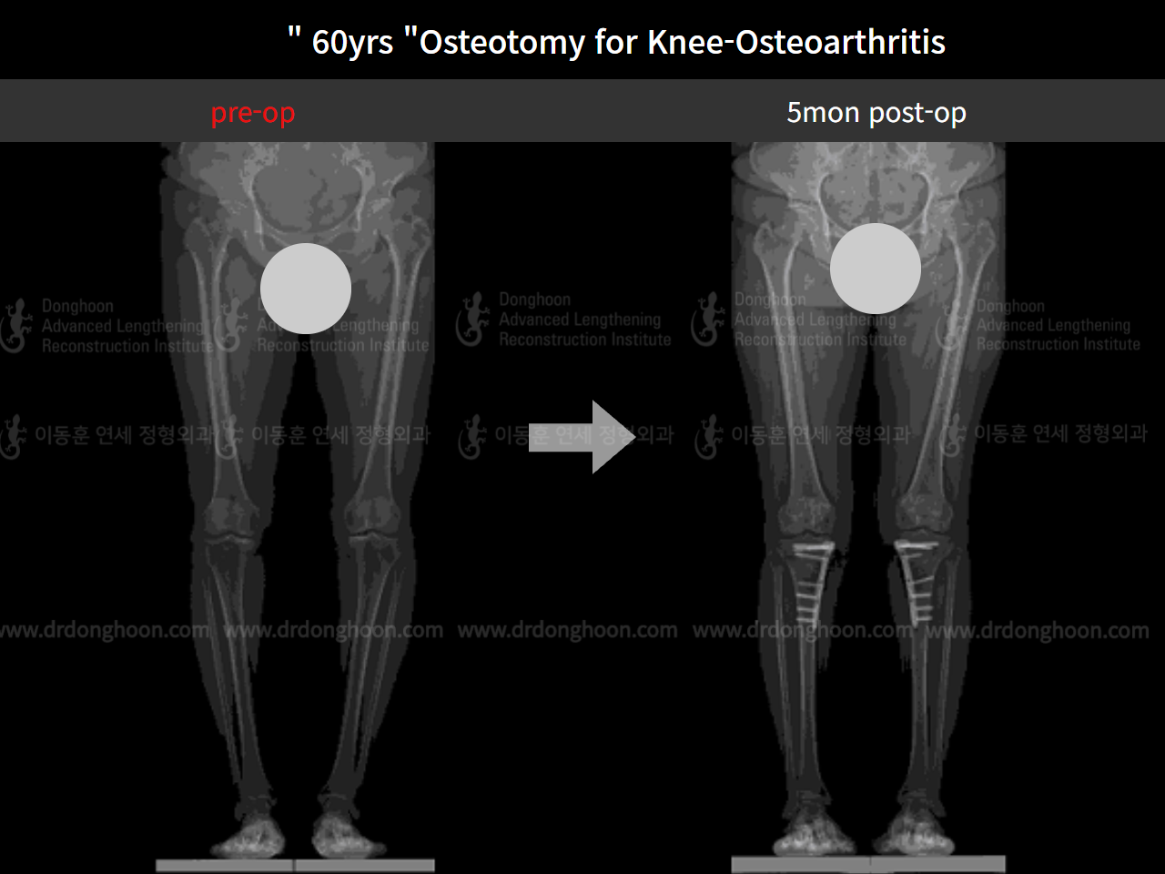 Before and after osteotomy for knee osteoarthritis, case 4586357, image 6, Dr. Donghoon institute (DALRI)