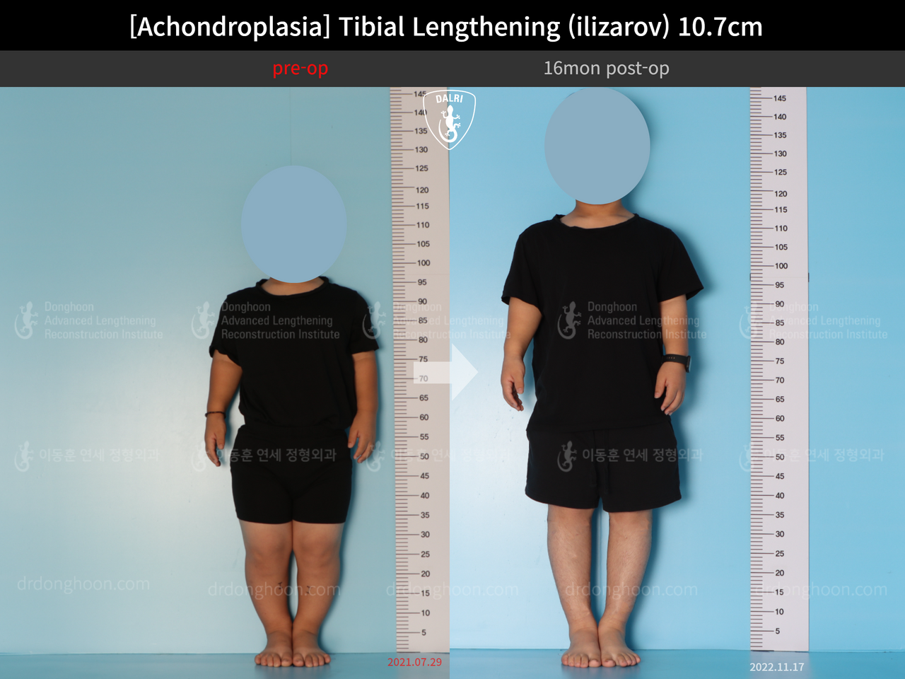 Before and after paediatric congenital condition, case 13489647, image 1, Dr. Donghoon institute (DALRI)