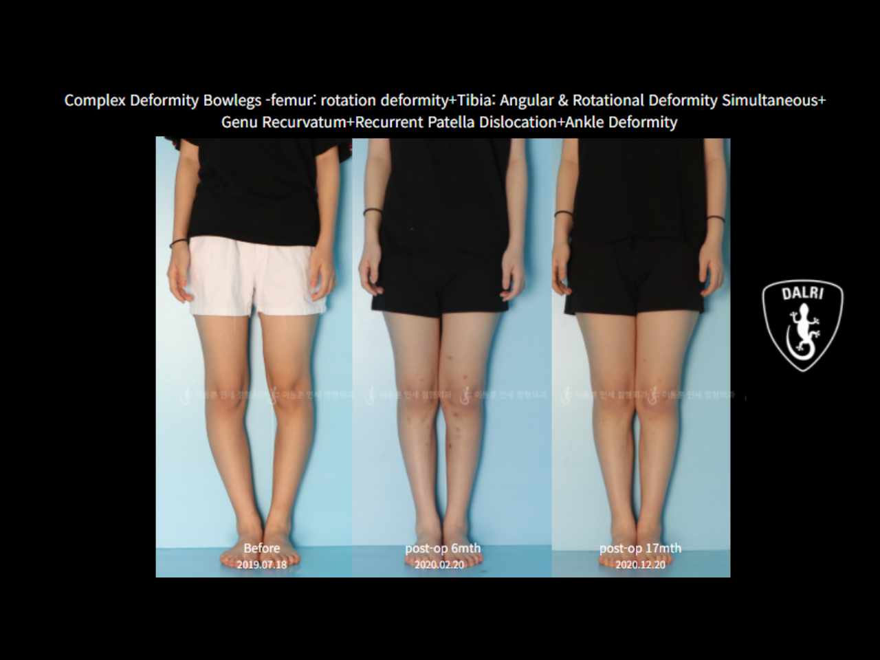 Before and after adult bowlegs, case 6883070, image 8, Dr. Donghoon institute (DALRI)