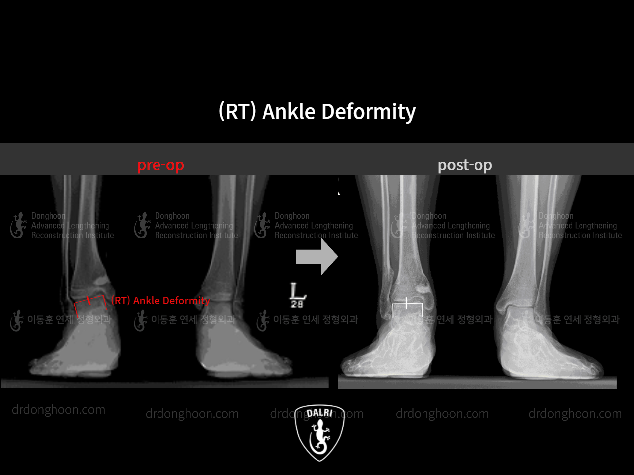 Before and after foot & ankle deformity, case 4248008, image 4, Dr. Donghoon institute (DALRI)