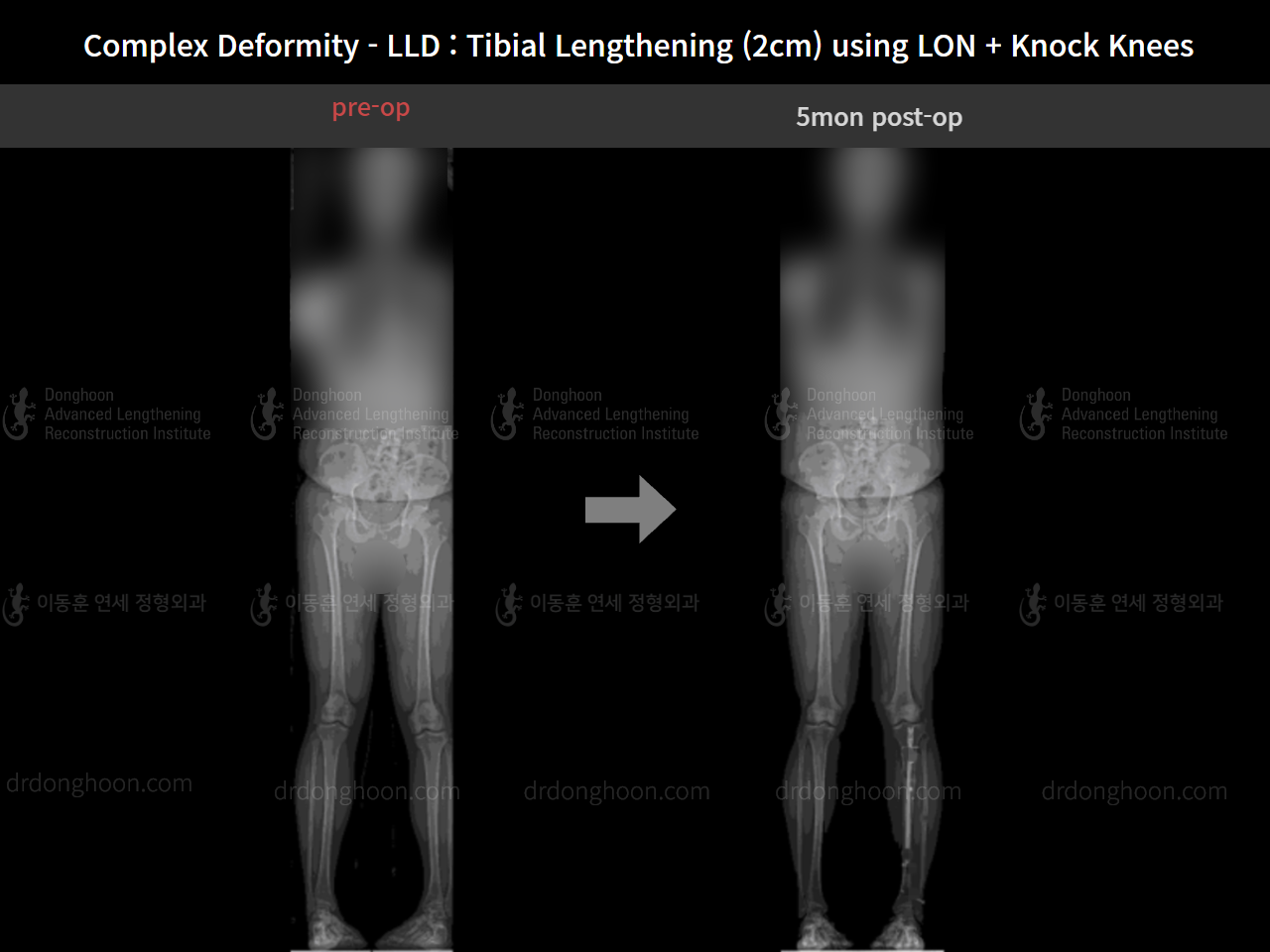 Before and after complex deformity, case 8394665, image 5, Dr. Donghoon institute (DALRI)