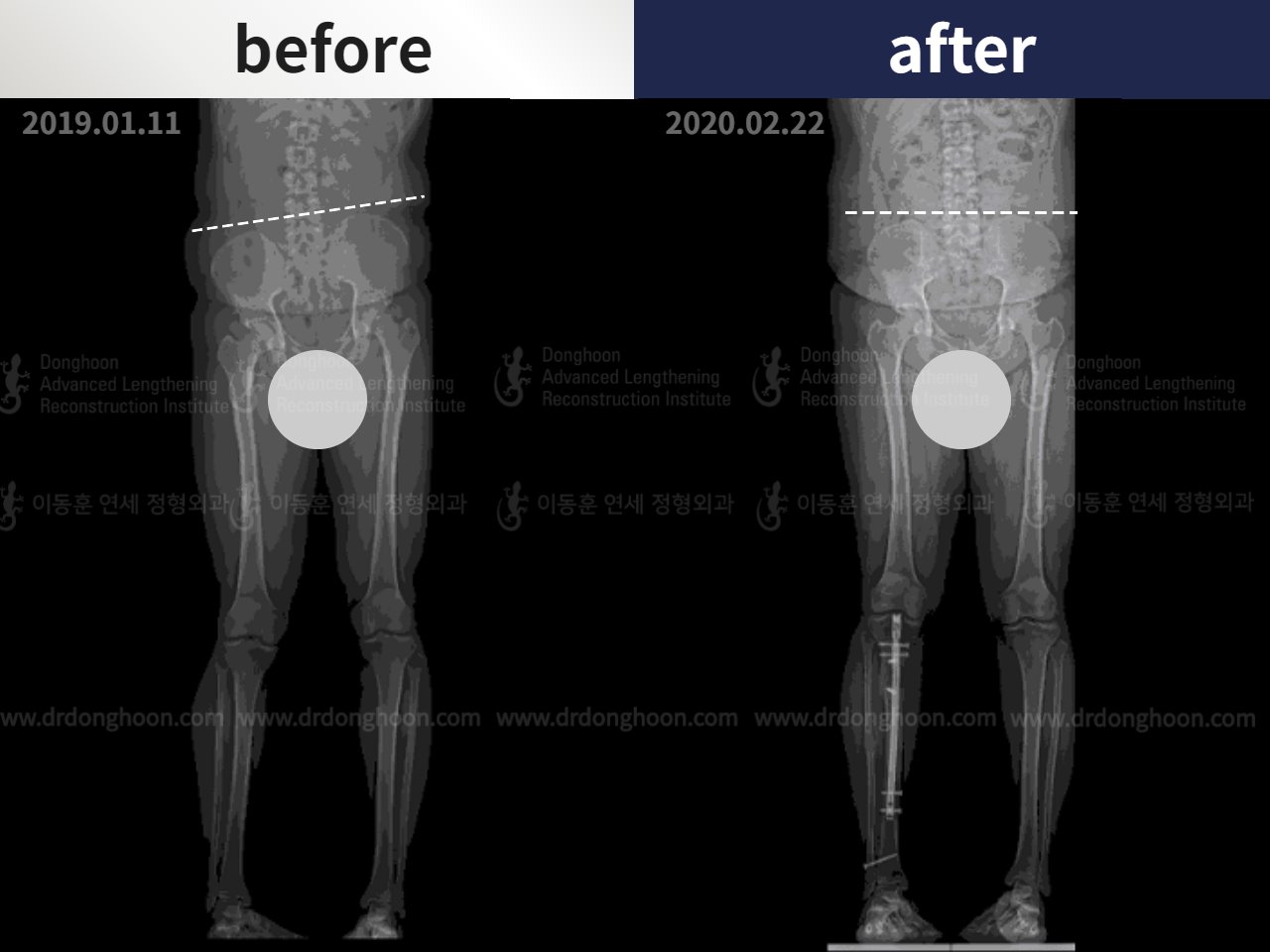 Before and after adult lld, case 4684471, image 3, Dr. Donghoon institute (DALRI)