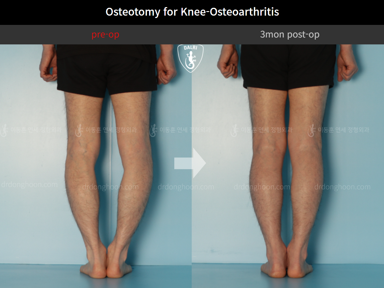 Before and after osteotomy for knee osteoarthritis, case 10445104, image 4, Dr. Donghoon institute (DALRI)