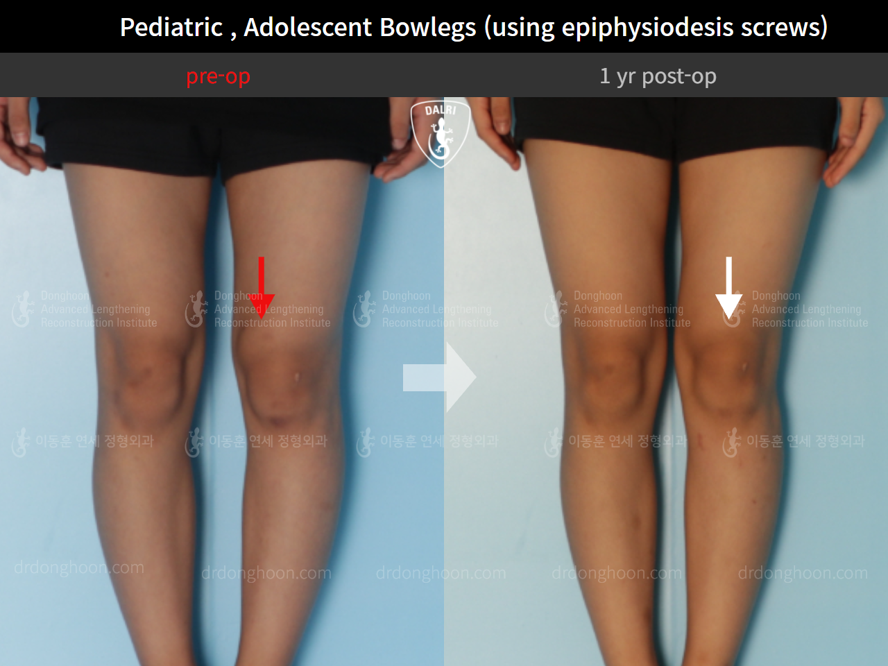 Before and after paediatric & adolescent bowlegs, case 9259159, image 3, Dr. Donghoon institute (DALRI)