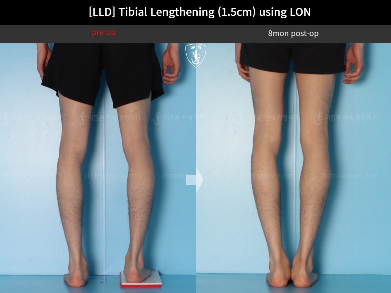 Before and after adult lld, case 18244334, image 6, Dr. Donghoon institute (DALRI)