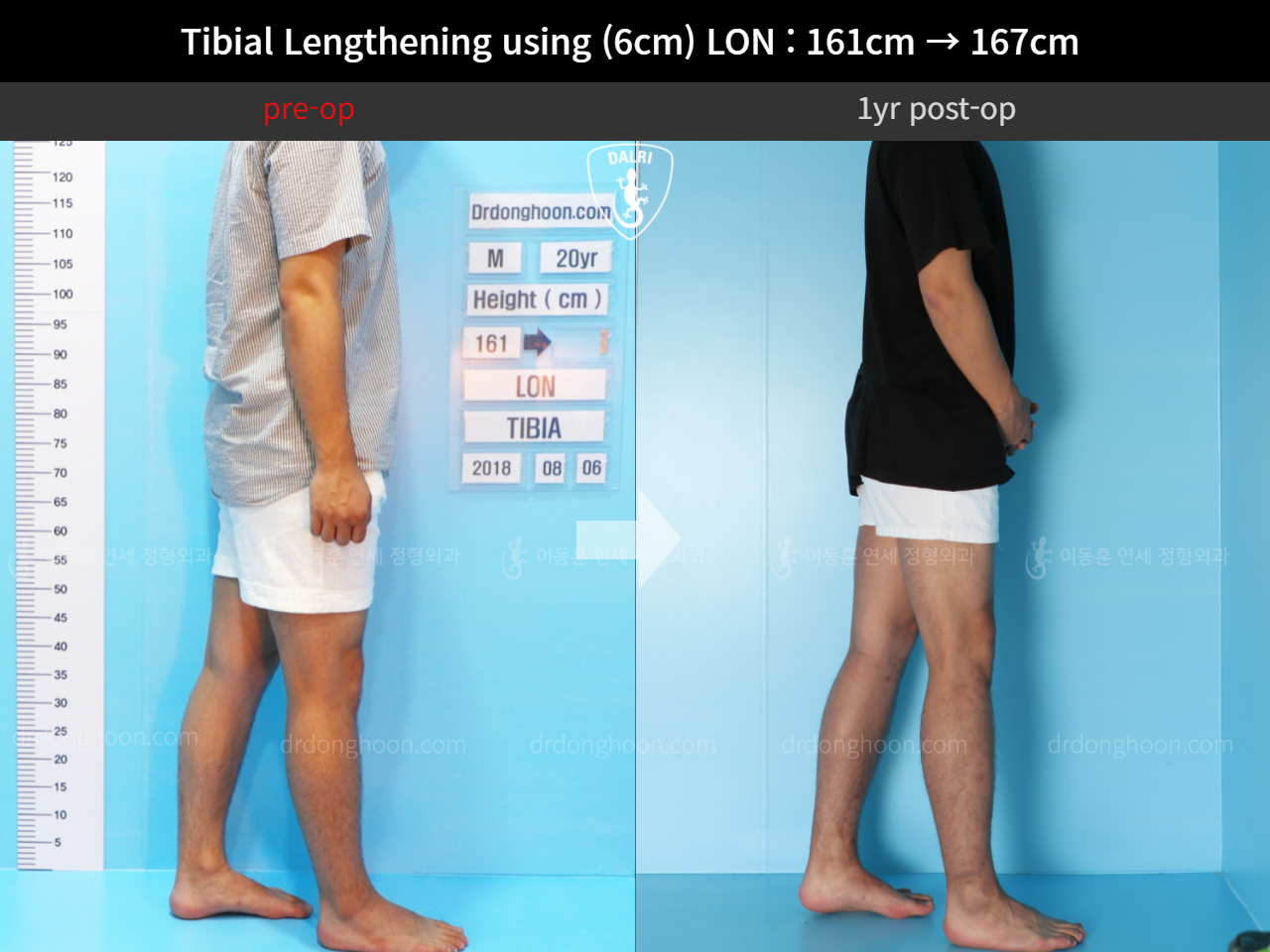 Before and after cll lon, case 11654440, image 5, Dr. Donghoon institute (DALRI)