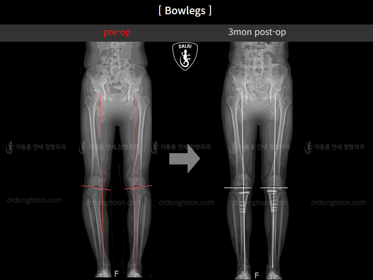 Before and after adult bowlegs, case 4311053, image 9, Dr. Donghoon institute (DALRI)