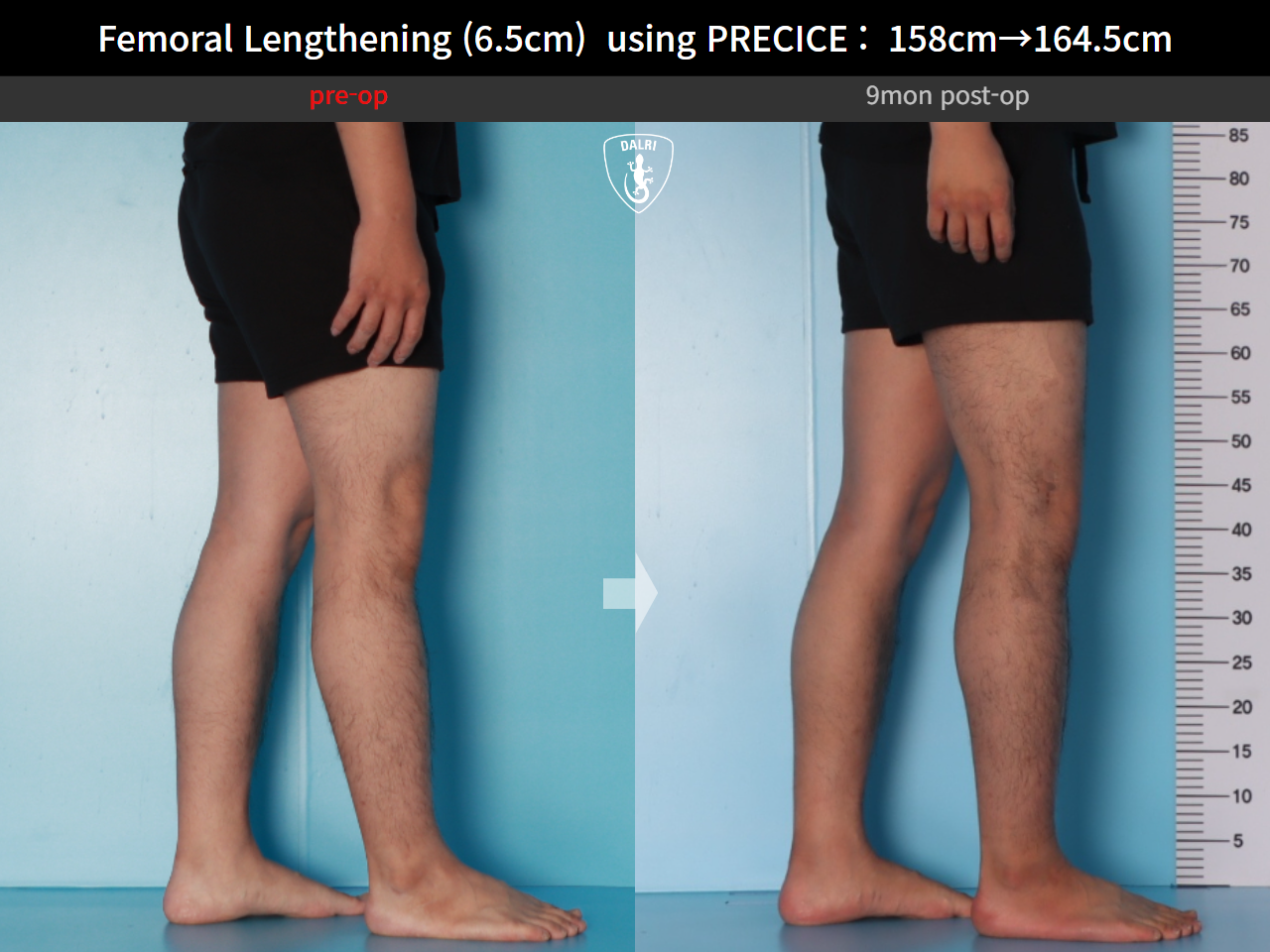 Before and after cll precice, case 28297898, image 10, Dr. Donghoon institute (DALRI)