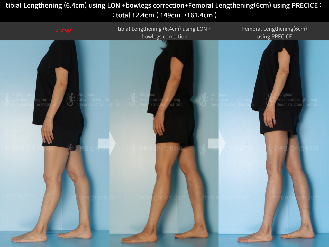Before and after cll precice, case 13696246, image 4, Dr. Donghoon institute (DALRI)