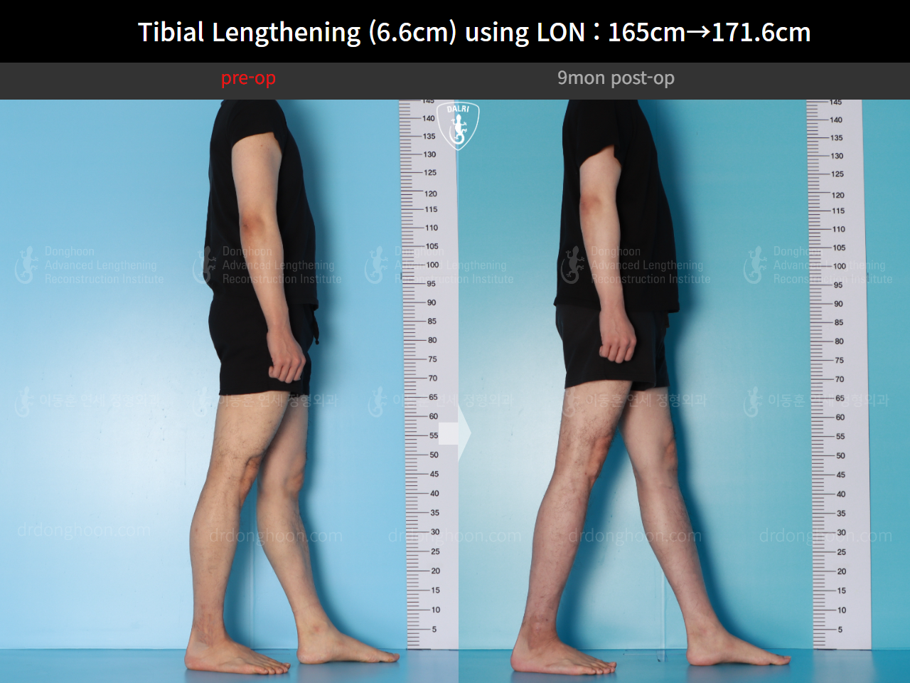 Before and after cll lon, case 16780660, image 8, Dr. Donghoon institute (DALRI)