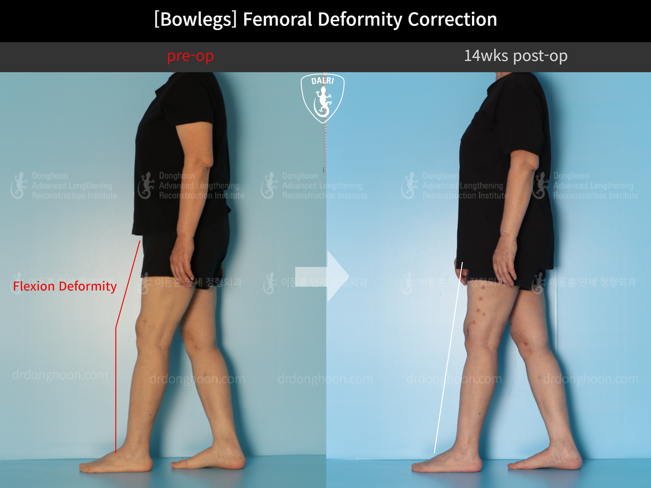 Before and after adult bowlegs, case 12791222, image 5, Dr. Donghoon institute (DALRI)