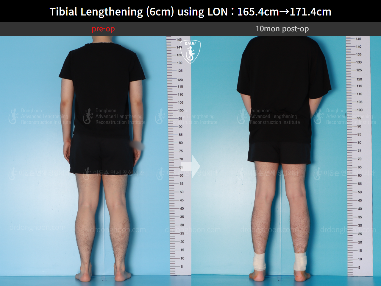 Before and after cll lon, case 15716525, image 4, Dr. Donghoon institute (DALRI)