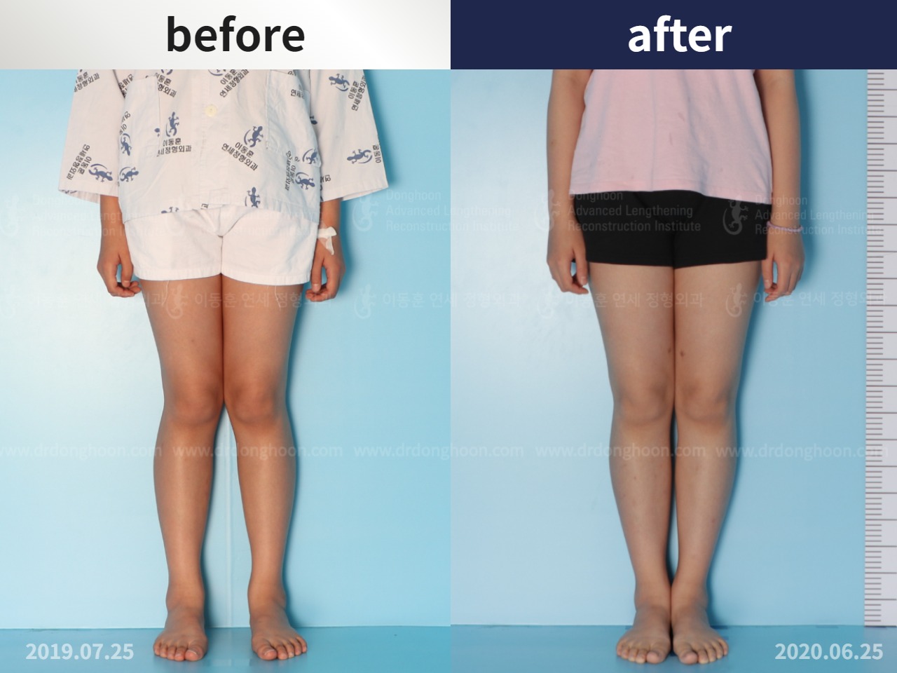 Before and after paediatric & adolescent knock knees, case 4640482, image 1, Dr. Donghoon institute (DALRI)