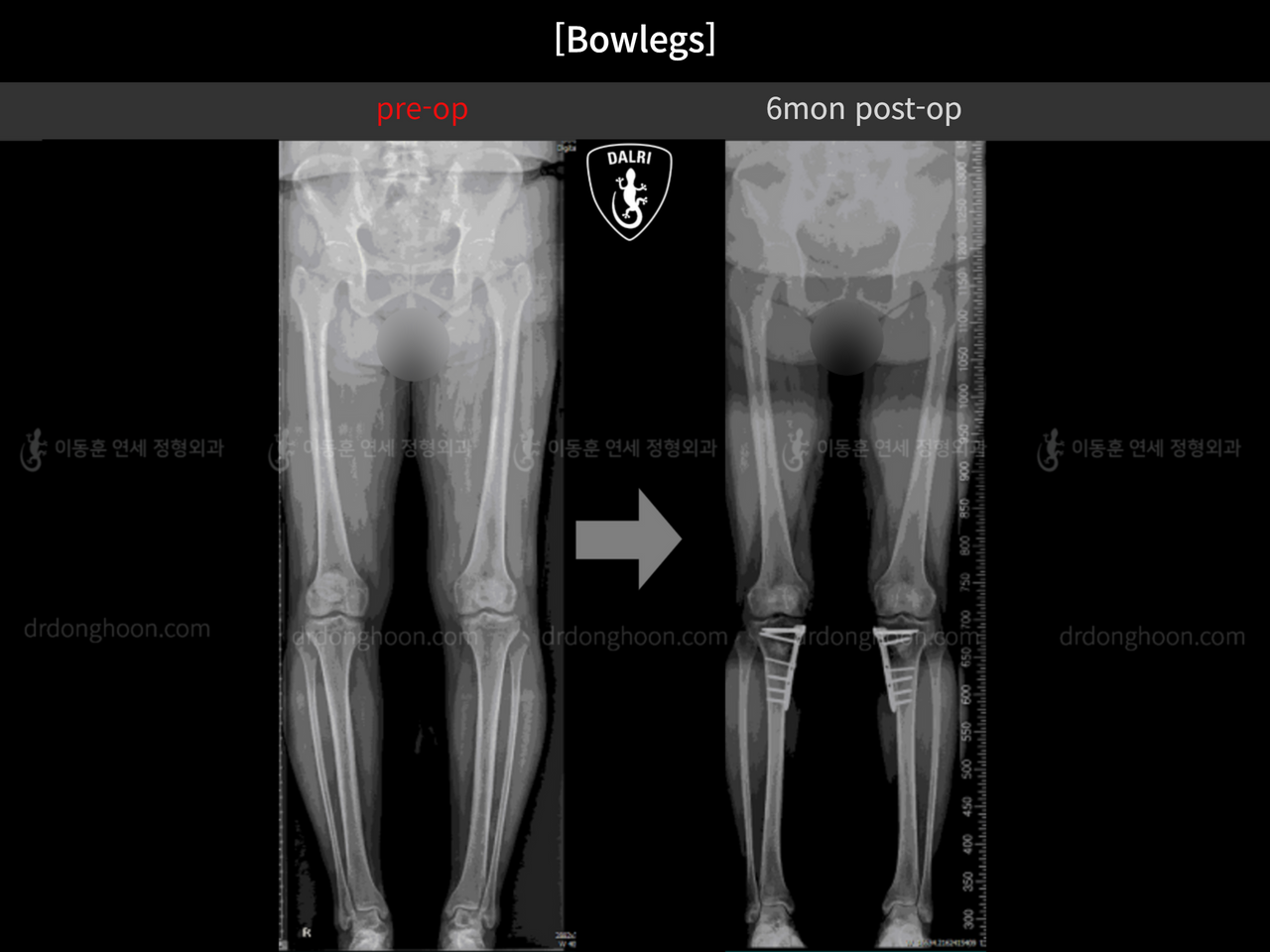 Before and after adult bowlegs, case 12396052, image 9, Dr. Donghoon institute (DALRI)